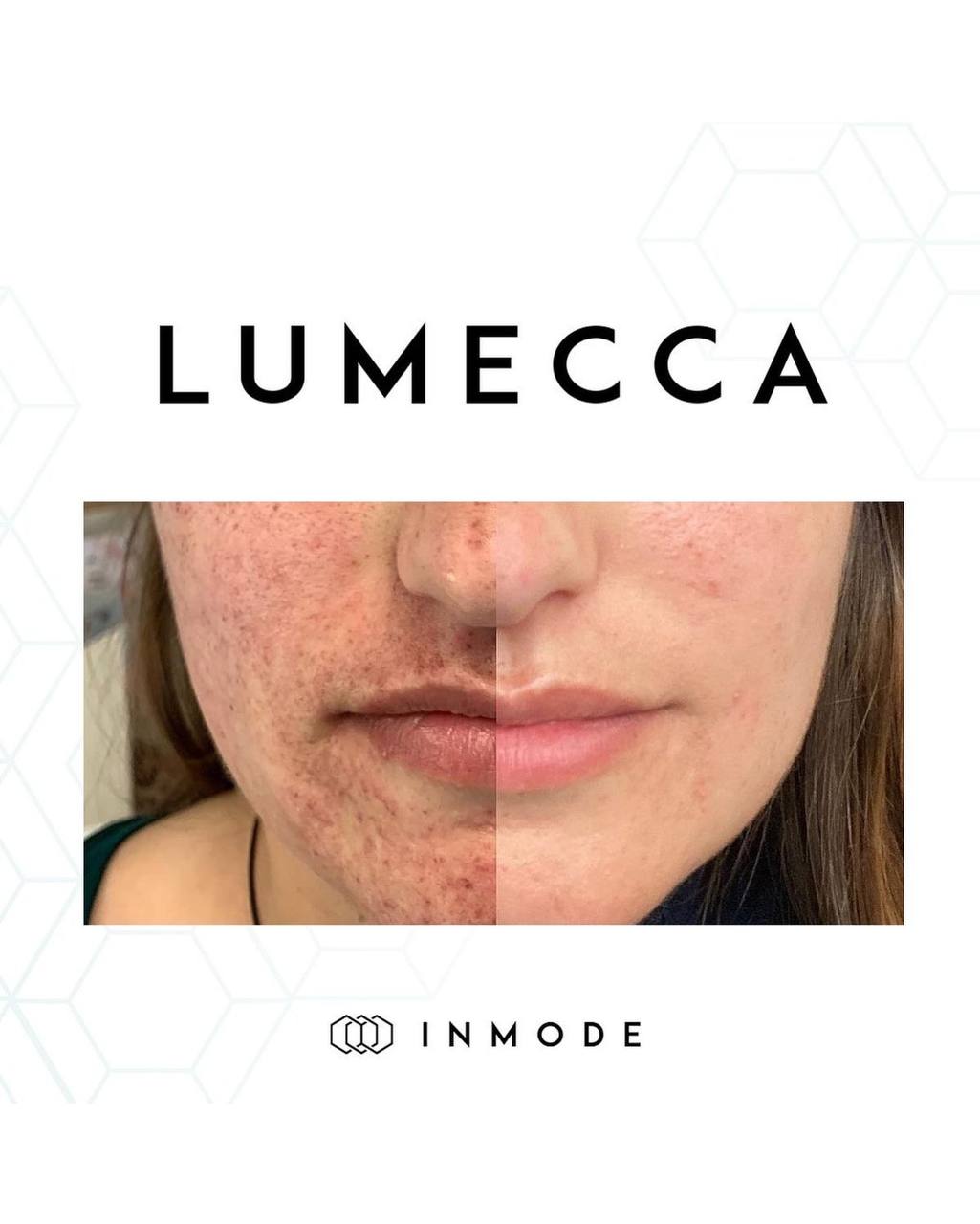 IPL Lumecca 2