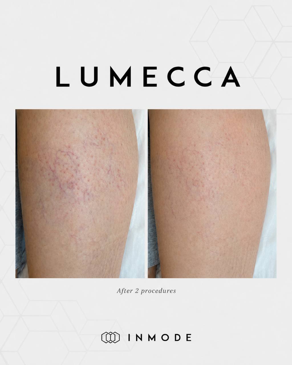 IPL Lumecca Legs 1