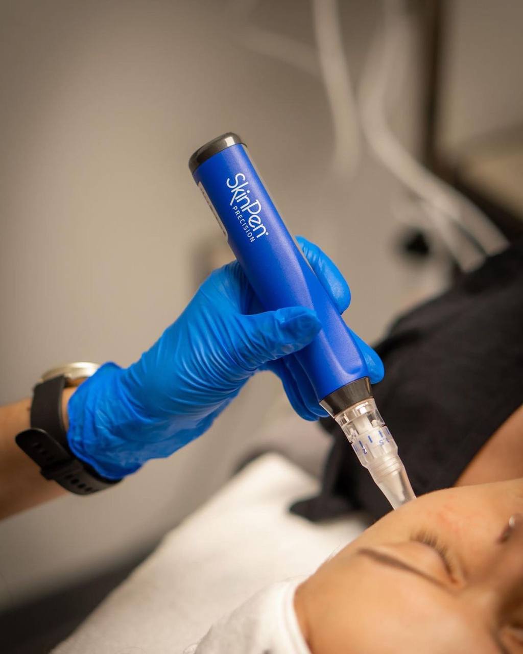 Microneedling SkinPen 1
